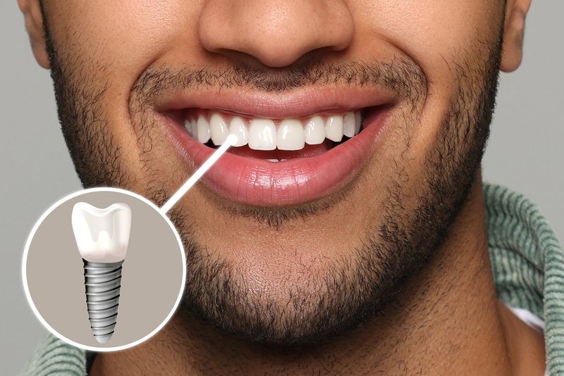 Dental Implants Newcastle