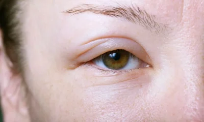 Facial Puffiness