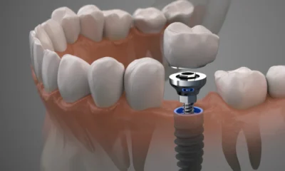 Dental Implants Newcastle Patients