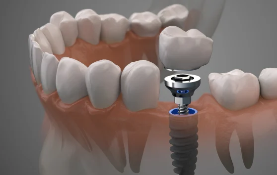 Dental Implants Newcastle Patients