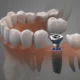 Dental Implants Newcastle Patients