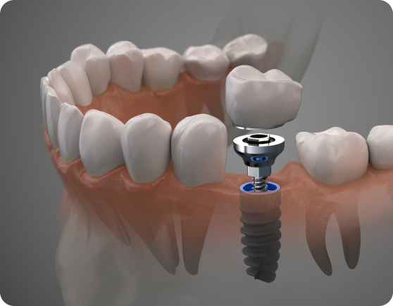 Dental Implants Newcastle Patients