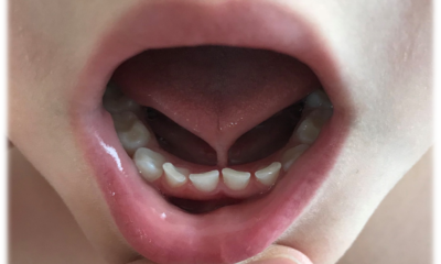 Ankyloglossia Symptoms: A Comprehensive Guide to Identifying Tongue Tie