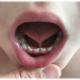 Ankyloglossia Symptoms: A Comprehensive Guide to Identifying Tongue Tie