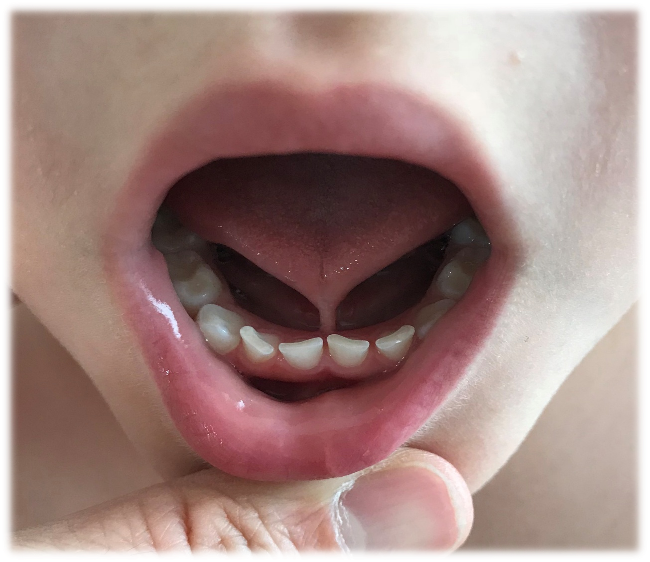 Ankyloglossia Symptoms: A Comprehensive Guide to Identifying Tongue Tie