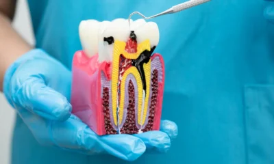 Root Canal