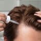 Hair Loss Treatment for Men Effective Solutions to Prevent Thinning